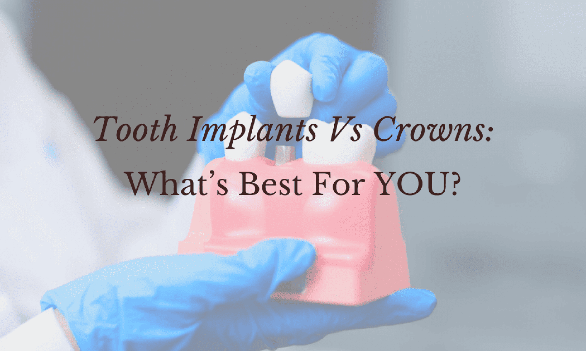 Tooth Implants Vs Crowns_ What’s Best For YOU