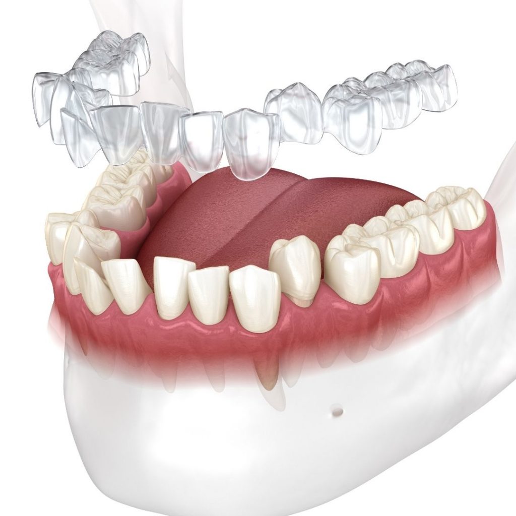 Benefits of Invisalign