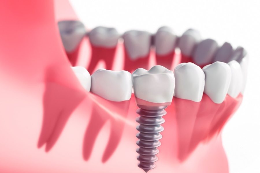 Dental Implants