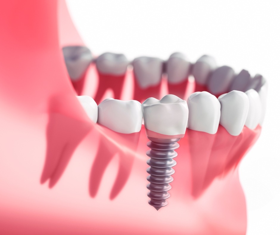 Dental Implants