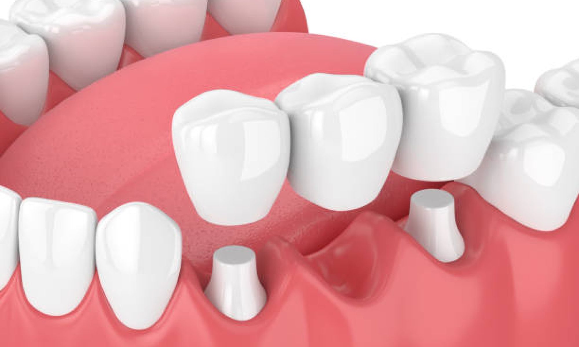 Dental Bridge