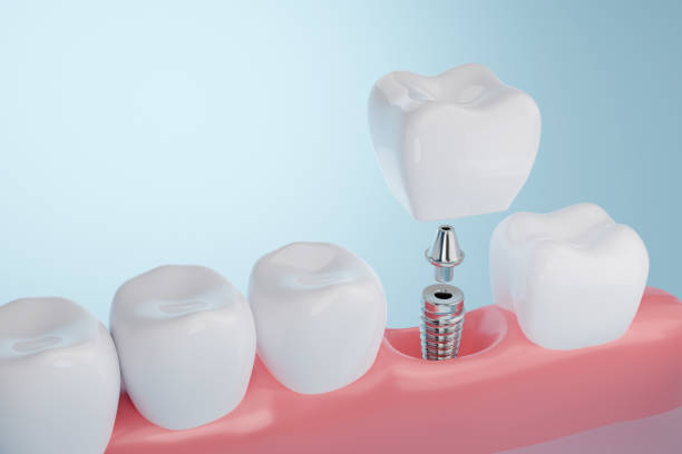 Tooth Implants