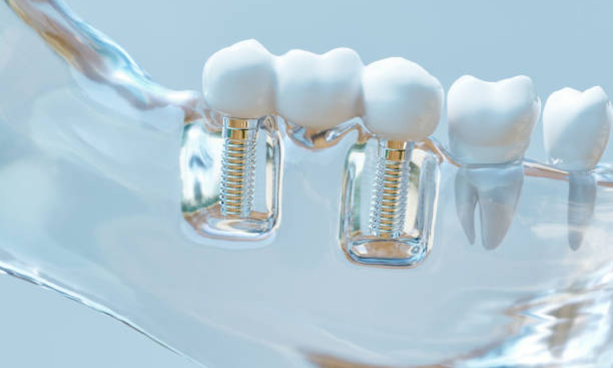 Dental implants