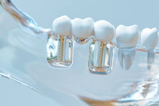 Dental implants