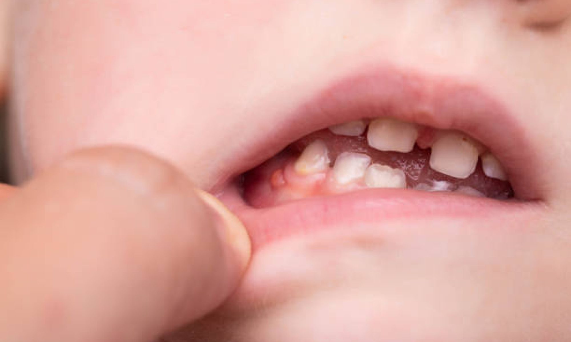 gum infection in kids