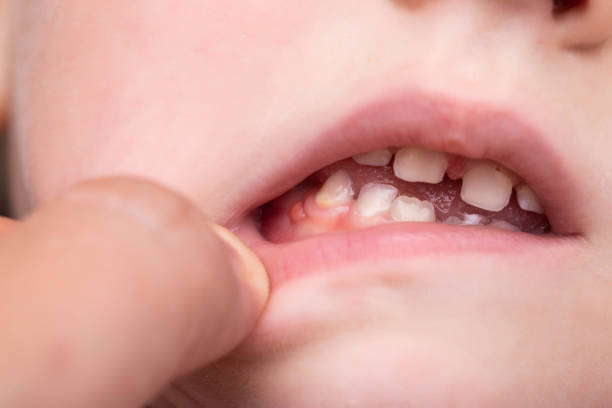 gum infection in kids