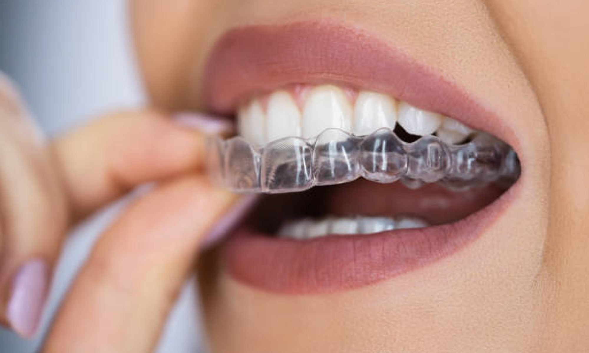 Clear Aligner