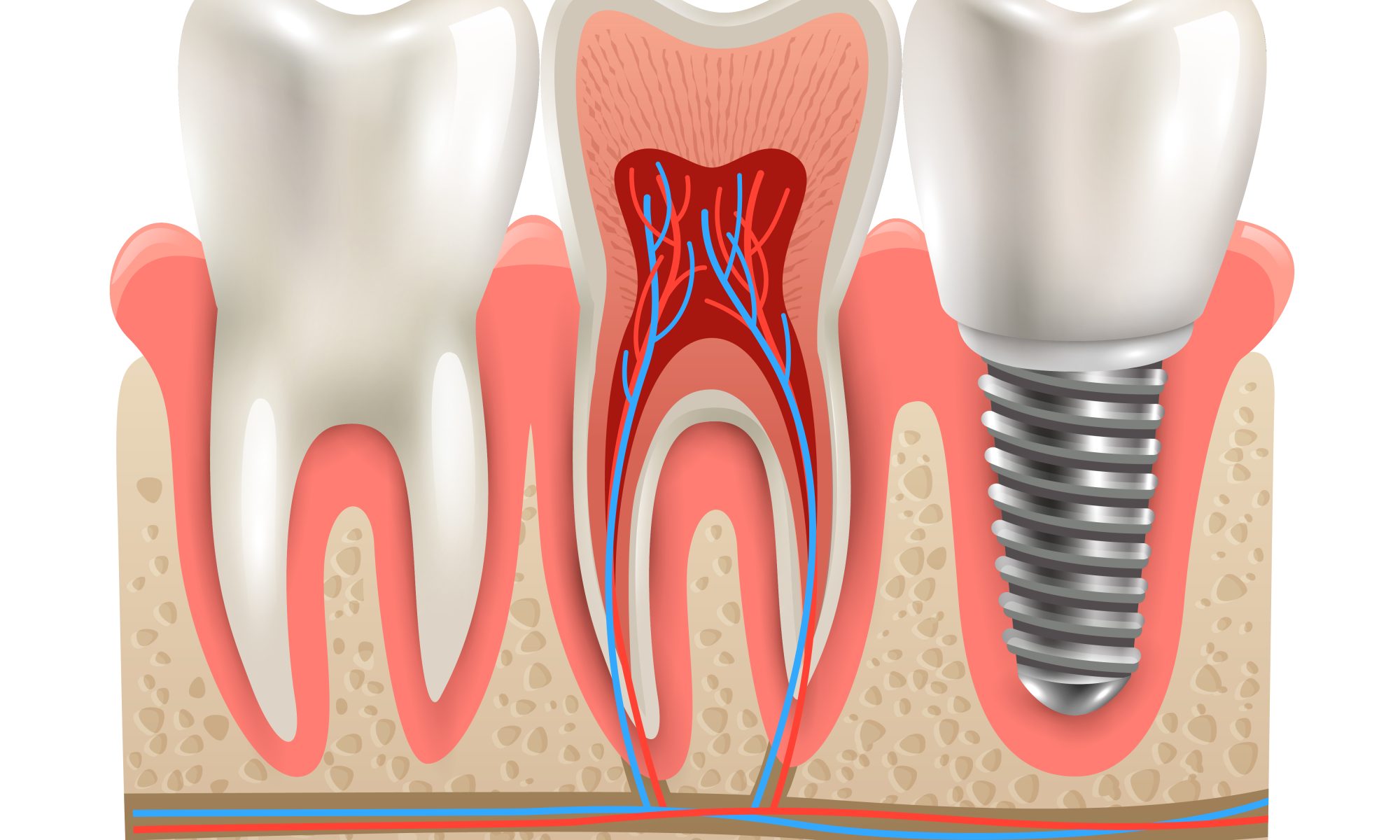 Dental Crown