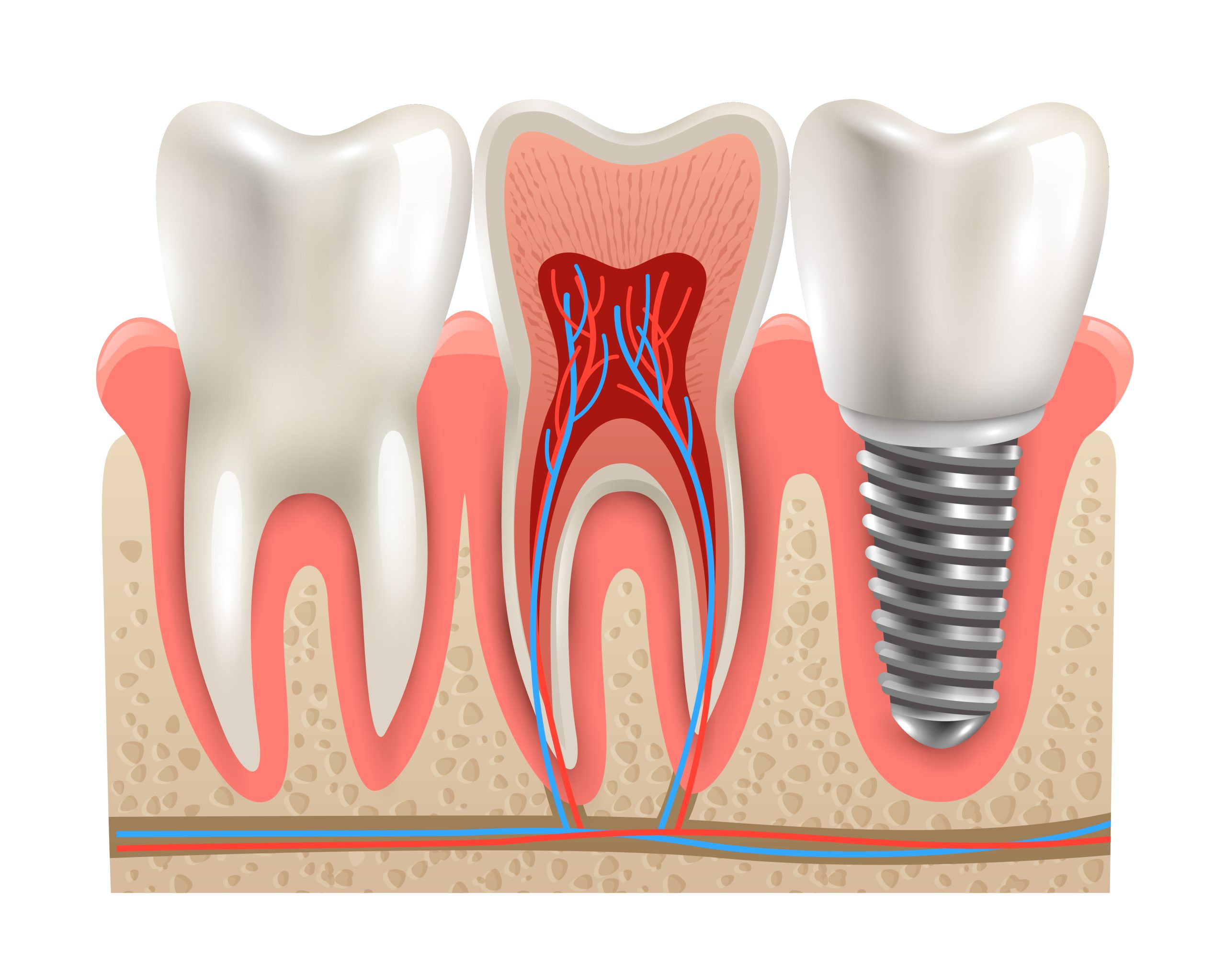 Dental Crown