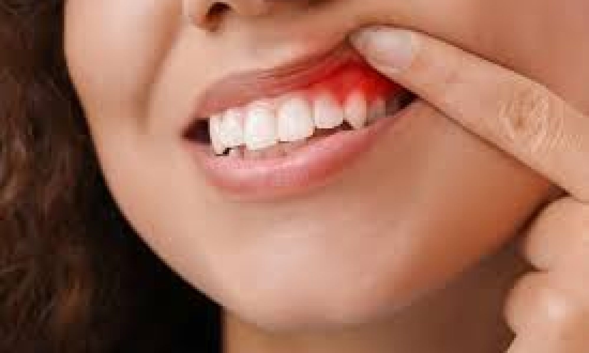 Gums Infection