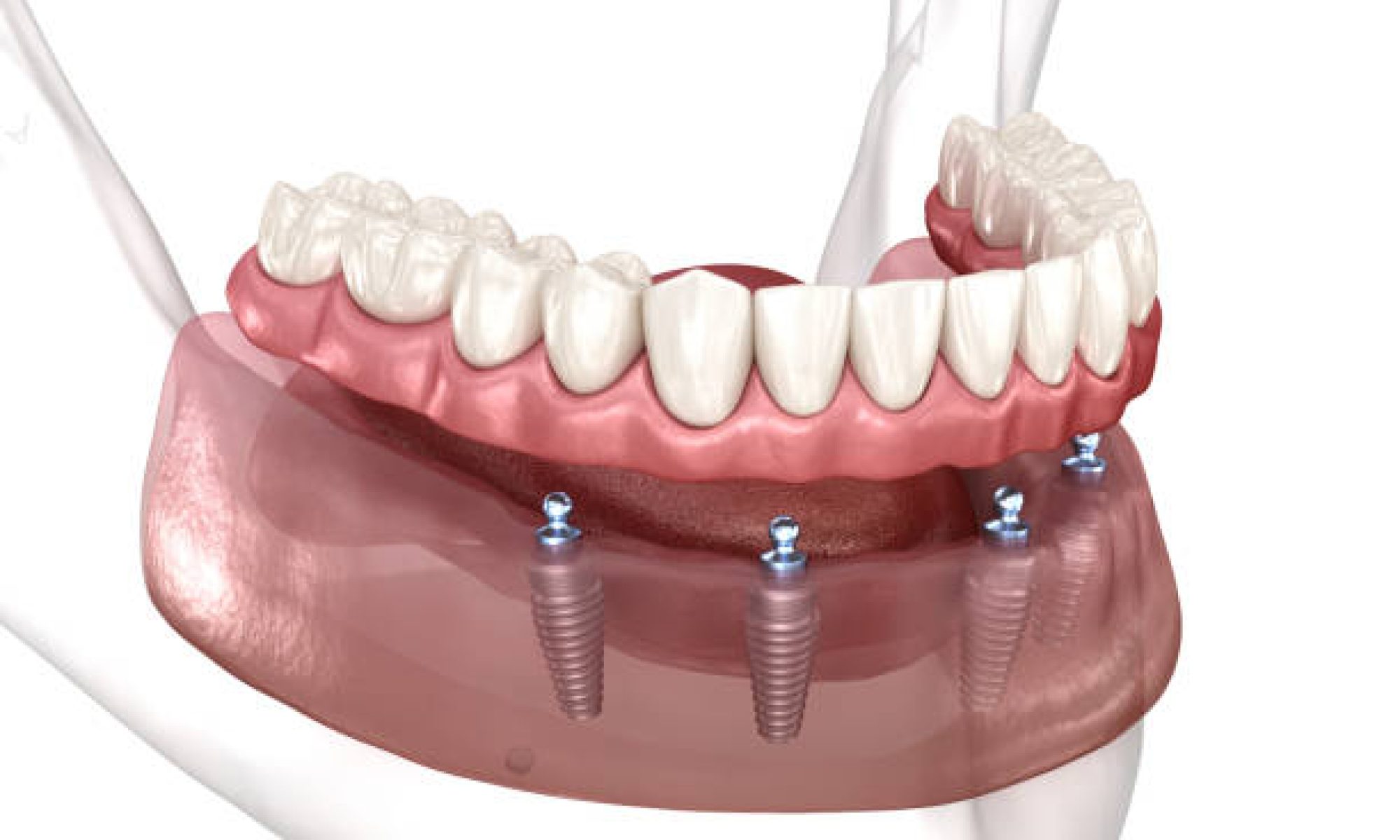 All-on-4 Dental Implants