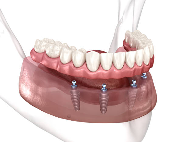 All-on-4 Dental Implants