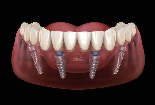 All-on-4 Dental Implants