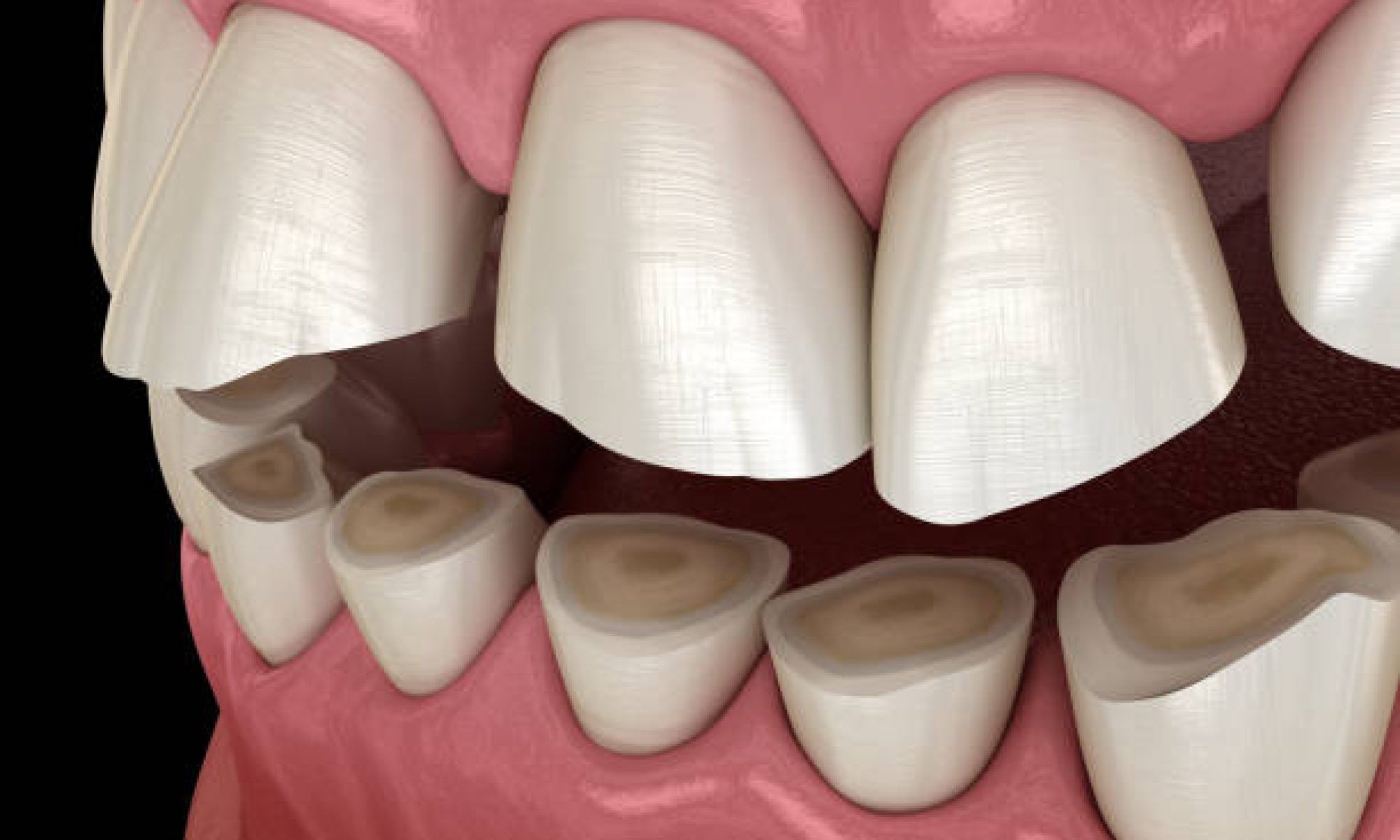 teeth erosion