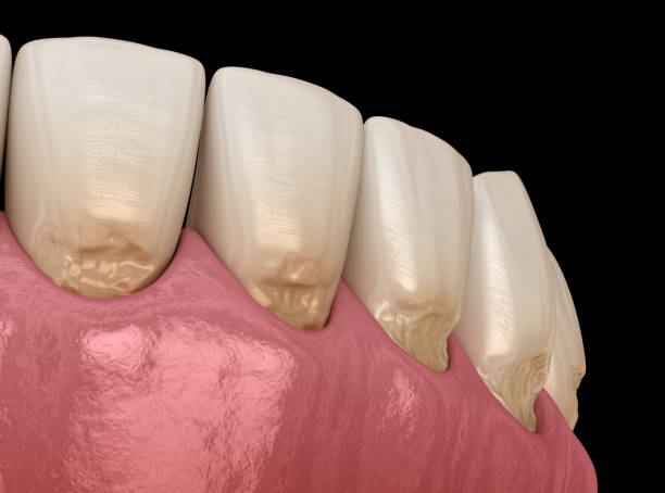 teeth erosion